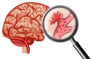 Hemorrhagic Stroke