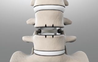 artificial disc replacement at Atlantic Brain and Spine