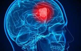 glioblastoma