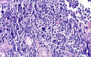 small cell lung cancer