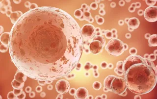 Metastatic Lung Cancer In The Brain