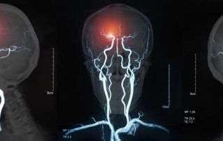 Understanding Brain Aneurysms