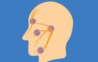 Illustration of facial nerves showing cranial nerve compression treated with microvascular decompression (MVD).