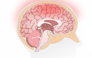 Idiopathic intracranial hypertension (IIH) causes elevated pressure inside the skull and can lead to papilledema and vision loss.