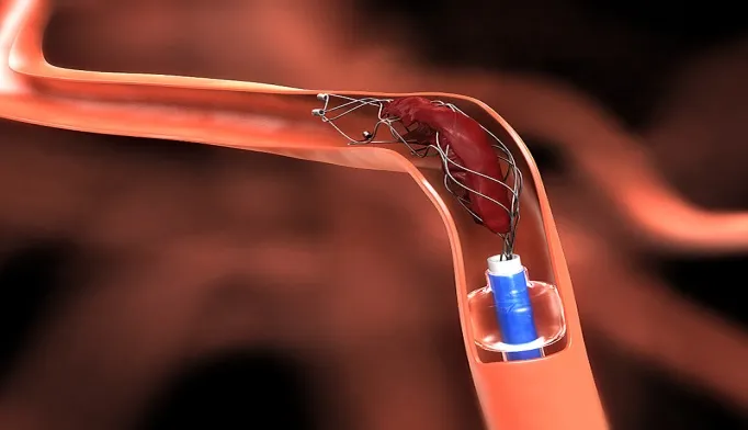 Endovascular Thrombectomy treatment at Atlantic Brain and Spine