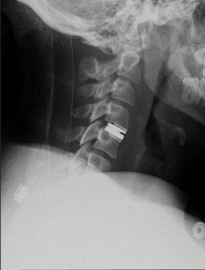 Lateral cervical spine X-ray showing an artificial disc replacement implant positioned between two vertebrae in the neck.